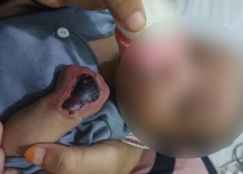 Tangan bayi melepuh setelah mendapat perawatan di RSUD Sultan Muhammad Jamaludin 1 Kayong Utara. Foto Dokumentasi