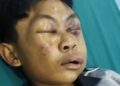 Kondisi Irfan Zaki Azizi, terlihat luka lebam hampir seluruhnya wajahnya yang diduga mengalami kekerasan di pondok pesantren.