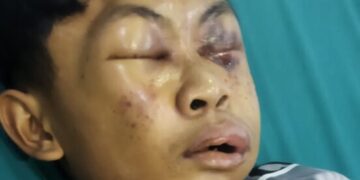 Kondisi Irfan Zaki Azizi, terlihat luka lebam hampir seluruhnya wajahnya yang diduga mengalami kekerasan di pondok pesantren.