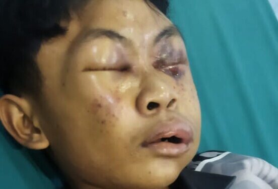 Kondisi Irfan Zaki Azizi, terlihat luka lebam hampir seluruhnya wajahnya yang diduga mengalami kekerasan di pondok pesantren.