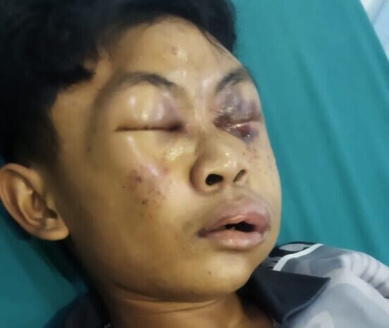 Kondisi Irfan Zaki Azizi, terlihat luka lebam hampir seluruhnya wajahnya yang diduga mengalami kekerasan di pondok pesantren.
